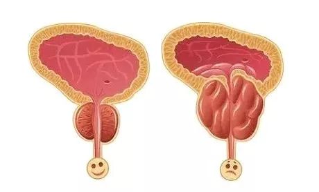 老公的前列腺增大挑戰(zhàn)，理解、支持與共同對抗，老公前列腺增大，理解、支持與共同應(yīng)對的挑戰(zhàn)