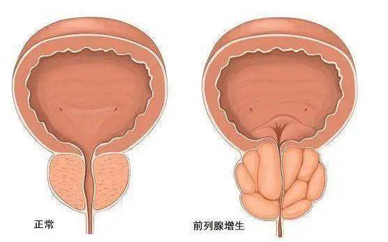 前列腺鈣化，一種常見的前列腺疾病及其相關(guān)知識(shí)解析，前列腺鈣化解析，常見疾病與相關(guān)知識(shí)探討