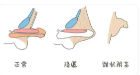 關(guān)于做包皮手術(shù)的費(fèi)用分析，包皮手術(shù)費(fèi)用詳解