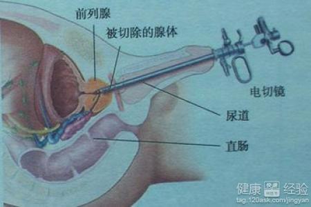 如何控制前列腺增生，如何控制前列腺增生的發(fā)展及癥狀？