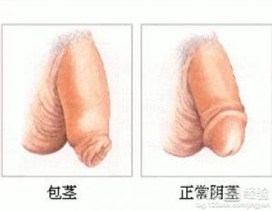 包莖過(guò)長(zhǎng)對(duì)身體的影響及應(yīng)對(duì)措施，包莖過(guò)長(zhǎng)對(duì)身體的影響與應(yīng)對(duì)措施解析