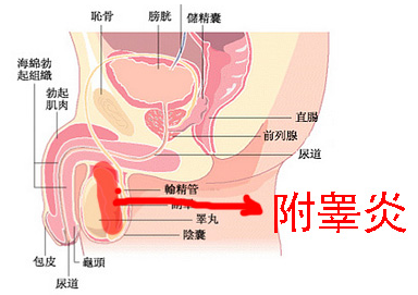 附睪炎，絕望中的希望曙光，附睪炎，絕望中的希望之光